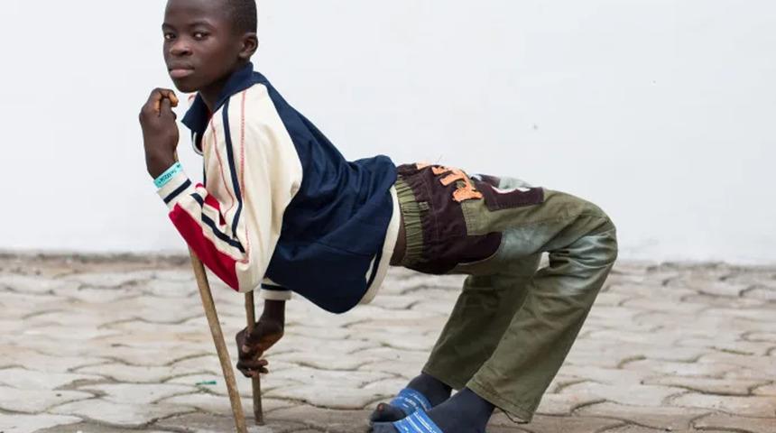 Yıllarca ikiye katlanmış halde yaşadı! Doktorlar bile ameliyatı reddetmişti