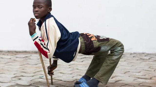 Yıllarca ikiye katlanmış halde yaşadı! Doktorlar bile ameliyatı reddetmişti