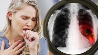 Tek sebebi sigara değil: Akciğer kanserini tetikleyen görünmez tehlikeler!