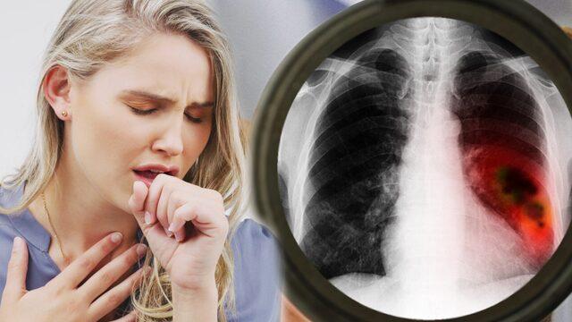 Tek sebebi sigara değil: Akciğer kanserini tetikleyen görünmez tehlikeler!
