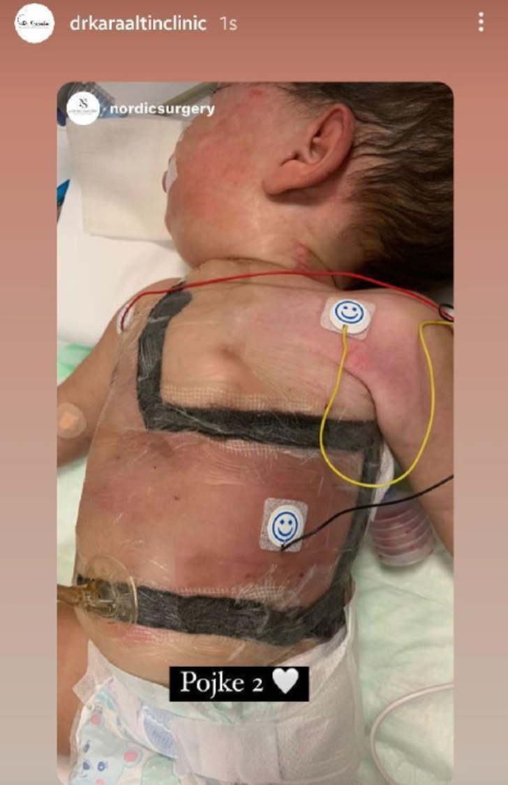 Aynı bedende yaşayan siyam ikizleri, Türkiye’de ayırıldı! Ameliyat tam 9 saat sürdü G2