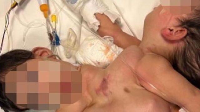 Aynı bedende yaşayan siyam ikizleri, Türkiye’de ayırıldı! Ameliyat tam 9 saat sürdü