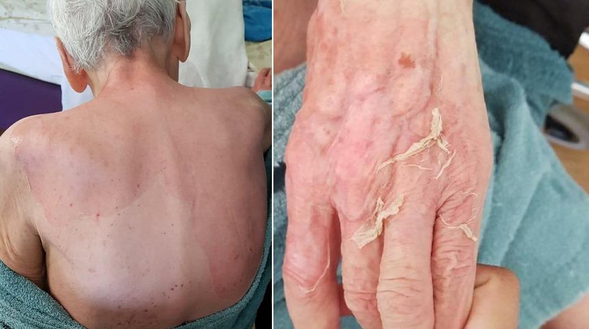 Huzurevinde yaşlı kadını ölüme götüren olay! 'Yanık değil' demişti! Rapor gerçeği ortaya çıkardı