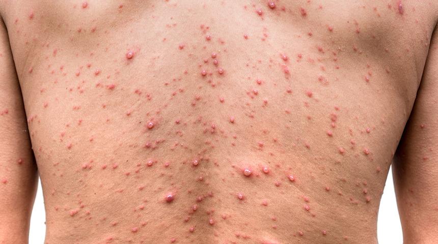 Sayı giderek artıyor! Maymun çiçeği vakaları endişe yarattı