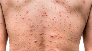 Sayı giderek artıyor! Maymun çiçeği vakaları endişe yarattı