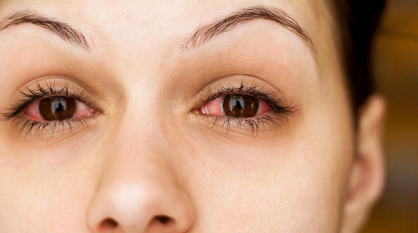 Severek yapıyorsunuz ama g&ouml;z enfeksiyonu riskini arttırıyor