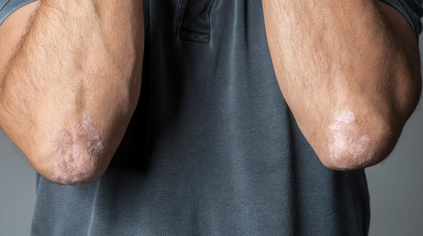 Sedef hastalarına müjde! Tedavisi yok zannetmeyin