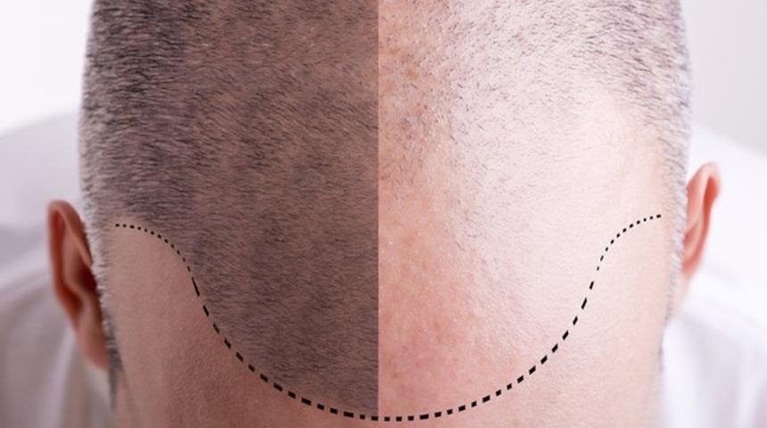 Saç ekimi hakkında her şey