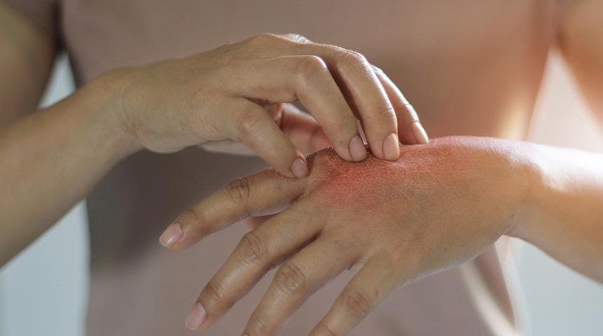 Yaz aylarında artıyor! Olmamak için yapmanız gereken…