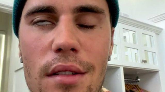 Justin Bieber: Ramsay Hunt sendromu nedir?