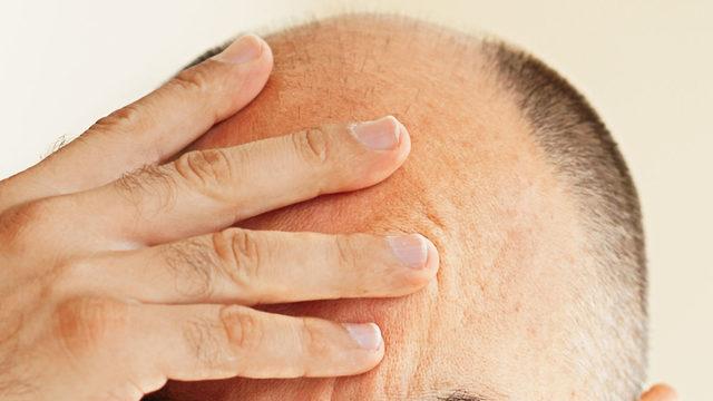 Kel kalma tarihe karışıyor! FDA’in onay verdiği ilaç milyonlara umut oldu