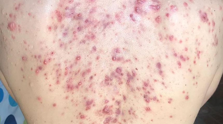 Utanmayın: Aynı derdi çeken milyonlar var! Bacne nedir? Sırt sivilceleri neden çıkar, nasıl geçer?