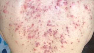 Utanmayın: Aynı derdi çeken milyonlar var! Bacne nedir? Sırt sivilceleri neden çıkar, nasıl geçer?