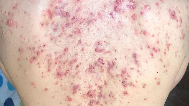 Utanmayın: Aynı derdi çeken milyonlar var! Bacne nedir? Sırt sivilceleri neden çıkar, nasıl geçer?