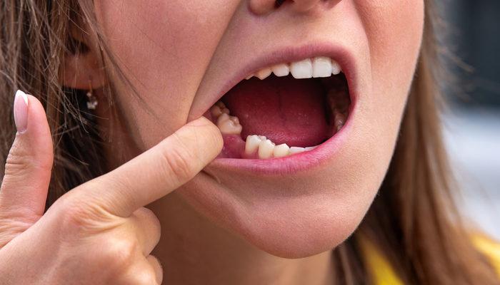 Herkes inatla bu hatayı yapıyor: Dişlerinizi tek tek kaybedeceksiniz! Diş sağlığında çok tehlikeli olan doğru bilinen yanlışlar