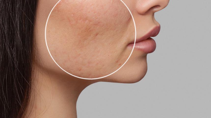 İlk uygulamada bile gözle görülür etki! Tek malzeme ile gözenekleri gideren maske