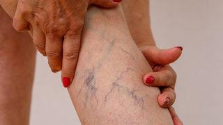 Yaz aylarında artıyor! Şikayetleri azaltmak için etkili öneriler