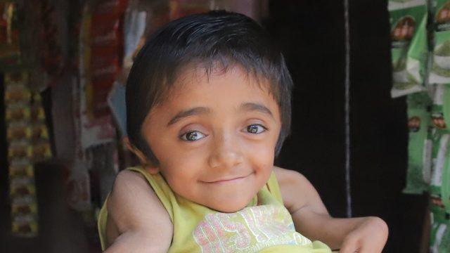 Kimse ona dokunamıyor! Hintli 12 yaşındaki kız ‘camdan’ kemikleriyle yaşam mücadelesi veriyor