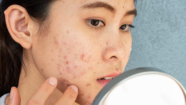 Çok az malzeme ile sivilcelere ve lekelerine en etkili maske tarifi