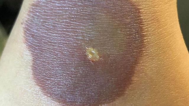 Sosyal medya trendi için kendini yaktı: Her şey 10 saniyede oldu