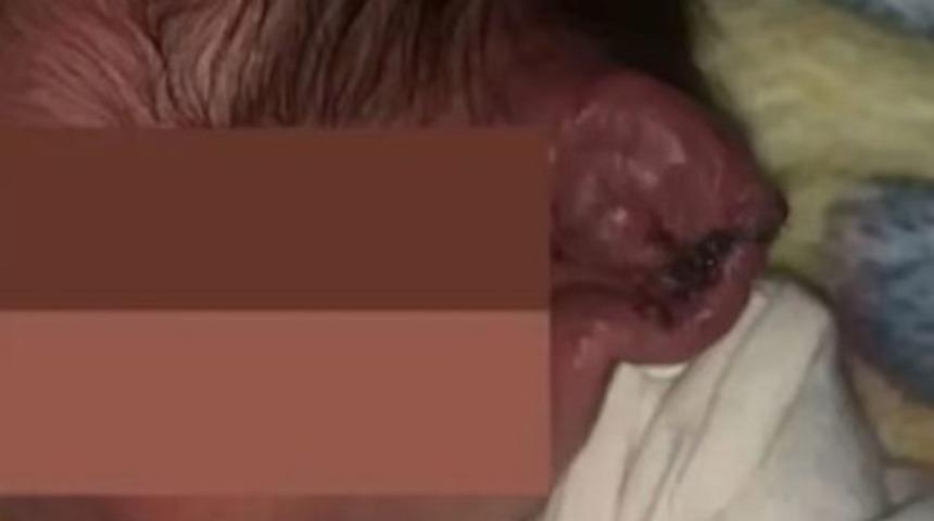 Doğumhanede elektrikler kesildi! Doktor telefon ışığıyla ameliyata devam edince yanlışlıkla bebeğin kulağını kesti