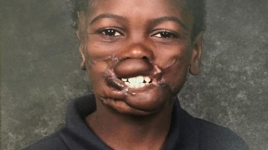 Kardeşi ve kuzeniyle birlikte şempanzelerin saldırısına uğradı! Maymunlar dudağını ve yanaklarını koparttı