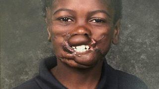 Kardeşi ve kuzeniyle birlikte şempanzelerin saldırısına uğradı! Maymunlar dudağını ve yanaklarını koparttı