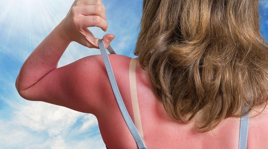 Soyulmadan, yanmadan bronzlaşmak mümkün! Güneşlenirken dikkat edin