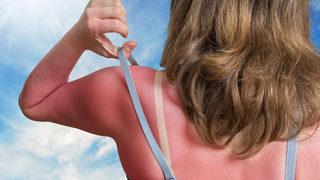 Soyulmadan, yanmadan bronzlaşmak mümkün! Güneşlenirken dikkat edin