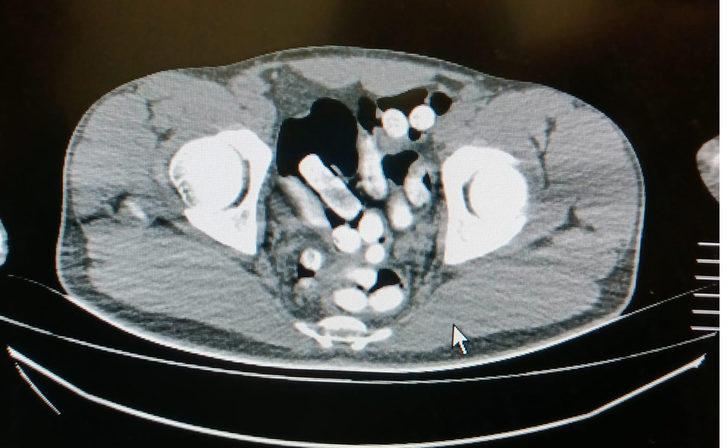 Ağrı'da bir yolcunun midesindeki kapsüllerde 1 kilo 126 gram uyuşturucu ele geçirildi G2