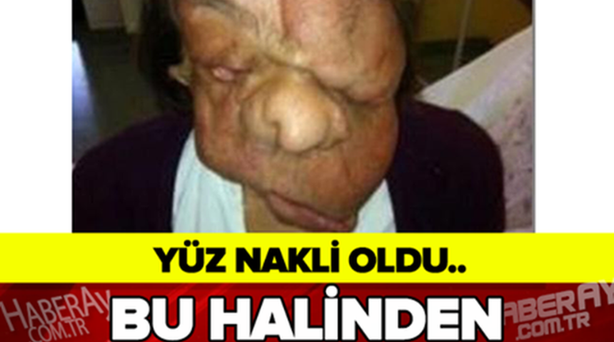Y&uuml;z Nakli Oldu Bu Halinden Eser Kalmadı İşte Yeni Hali