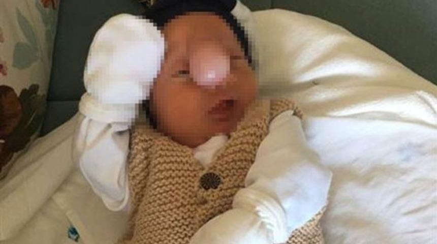 İki haftalık bebeğin yüzündeki kitle alındı