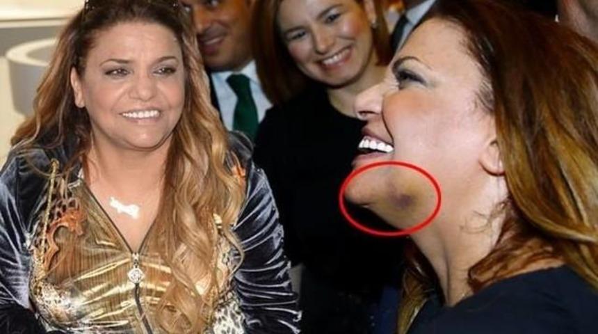 Kibariye Eşinden Dayak'mı Yedi Y&uuml;z&uuml; G&ouml;z&uuml; Mosmor Olan Kibariye'yi Kim D&ouml;vd&uuml;