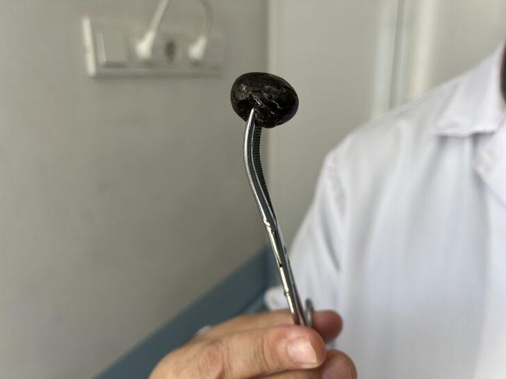Isparta'da mide rahatsızlığına iyi gelmesi için yuttuğu zeytin bağırsağını tıkadı G4
