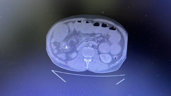 Isparta'da mide rahatsızlığına iyi gelmesi için yuttuğu zeytin bağırsağını tıkadı G5