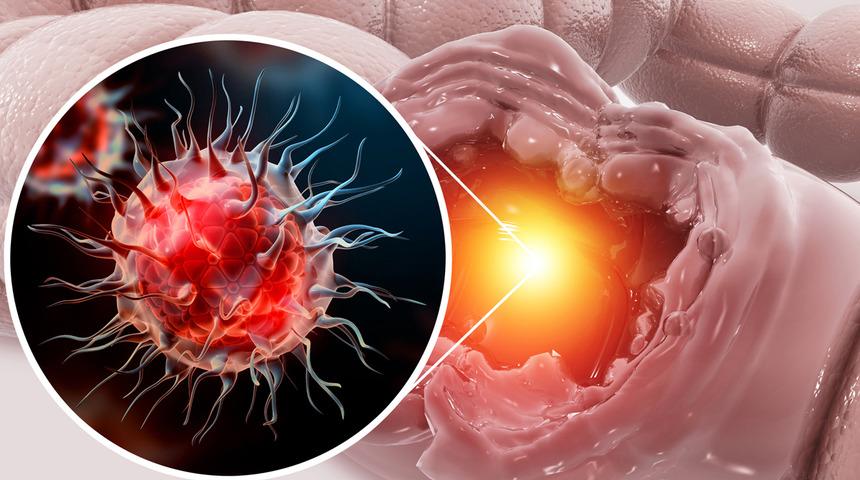 Kolon kanserine karşı çelik gibi koruyor! Günde 5 tanesi şifa gibi geliyor