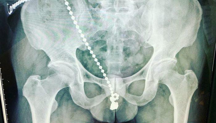 Akılalmaz olay! Metal boncuklu kolyeyi cinsel organına soktu, doktorlar tek tek çıkartmak zorunda kaldı