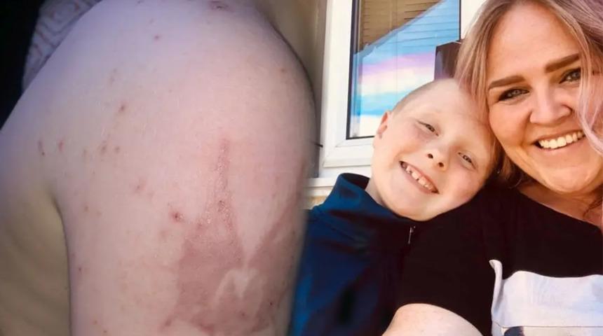 Türkiye’de yaşadığı tatil burnundan geldi! Endişeli anne kimyasal yanık hakkında uyardı