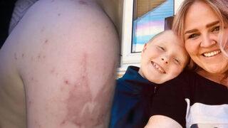 Türkiye’de yaşadığı tatil burnundan geldi! Endişeli anne kimyasal yanık hakkında uyardı