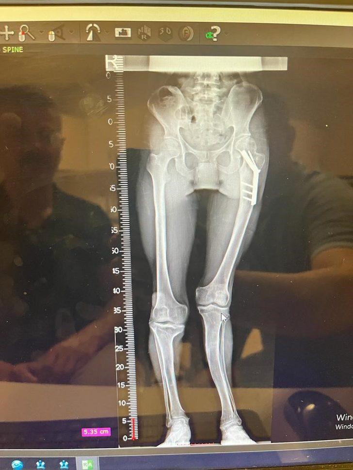 Mardin'de cam kemik hastasına cerrahi müdahale G4