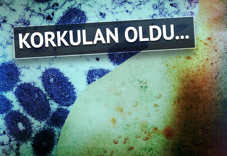 Son dakika: Maymun çiçeği virüsü Türkiye'de! Hastaya ilişkin detayları Bakan Koca açıkladı