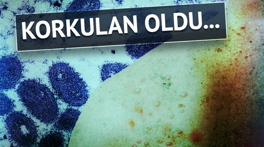 Son dakika: Maymun çiçeği virüsü Türkiye'de! Hastaya ilişkin detayları Bakan Koca açıkladı