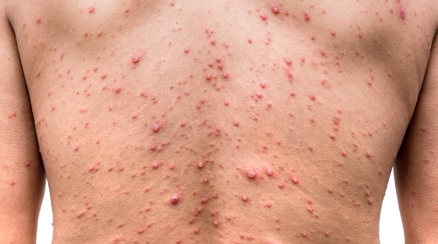 Türkiye’de de görüldü! Maymun çiçeği virüsü belirtileri nelerdir? Virüsten korunmak için ne yapmak gerekir?