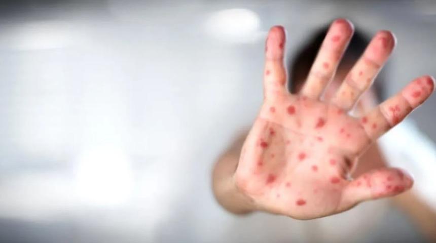 Maymun Çiçeği belirtileri neler? Maymun Çiçeği virüsü öldürür mü, nasıl bulaşır?