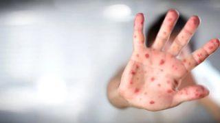 Maymun çiçeği nedir? Maymun çiçeği belirtileri nelerdir, nasıl bulaşır?