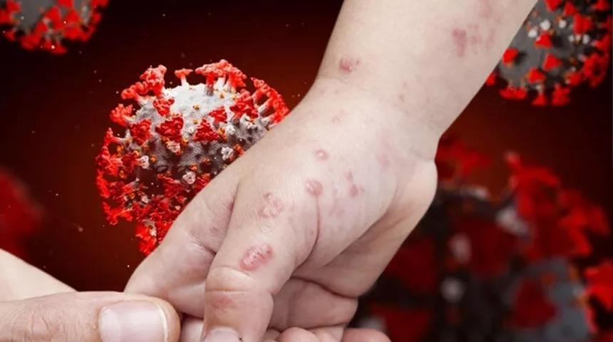 Maymun Çiçeği vaka sayısı kaç oldu? Maymun Çiçeği vakası Türkiye'de hangi illerde görüldü? Bakan Koca açıkladı!