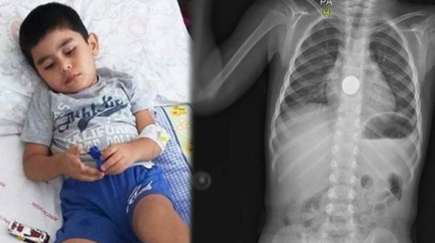 Bask&uuml;l pili yutan &ccedil;ocuğun yemek borusu yandı