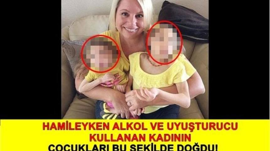 Hamileyken Alkol Ve Uyuşturucu Kullanan Anne'nin &Ccedil;ocukları Bakın Nasıl Doğdu!