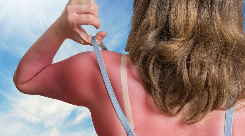 Geçirir sanıyorsunuz ama iz bırakabilir! Güneş yanığınızı tedavi etmek için sakın yapmayın