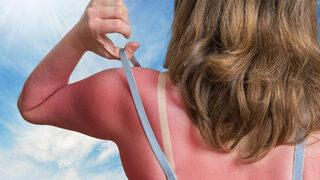 Geçirir sanıyorsunuz ama iz bırakabilir! Güneş yanığınızı tedavi etmek için sakın yapmayın